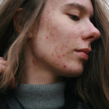 Arti Letak Jerawat di Wajah, Bisa Berkaitan dengan Pola Hidup