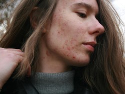 Arti Letak Jerawat di Wajah, Bisa Berkaitan dengan Pola Hidup