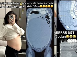 Cerita Wanita Surabaya Idap Kista Sebesar 33 Cm, Awalnya Dikira Perut Kembung