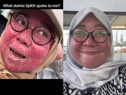Viral Wajah Wanita Jaksel Breakout Parah, Efek Pakai Krim Etiket Biru 10 Tahun