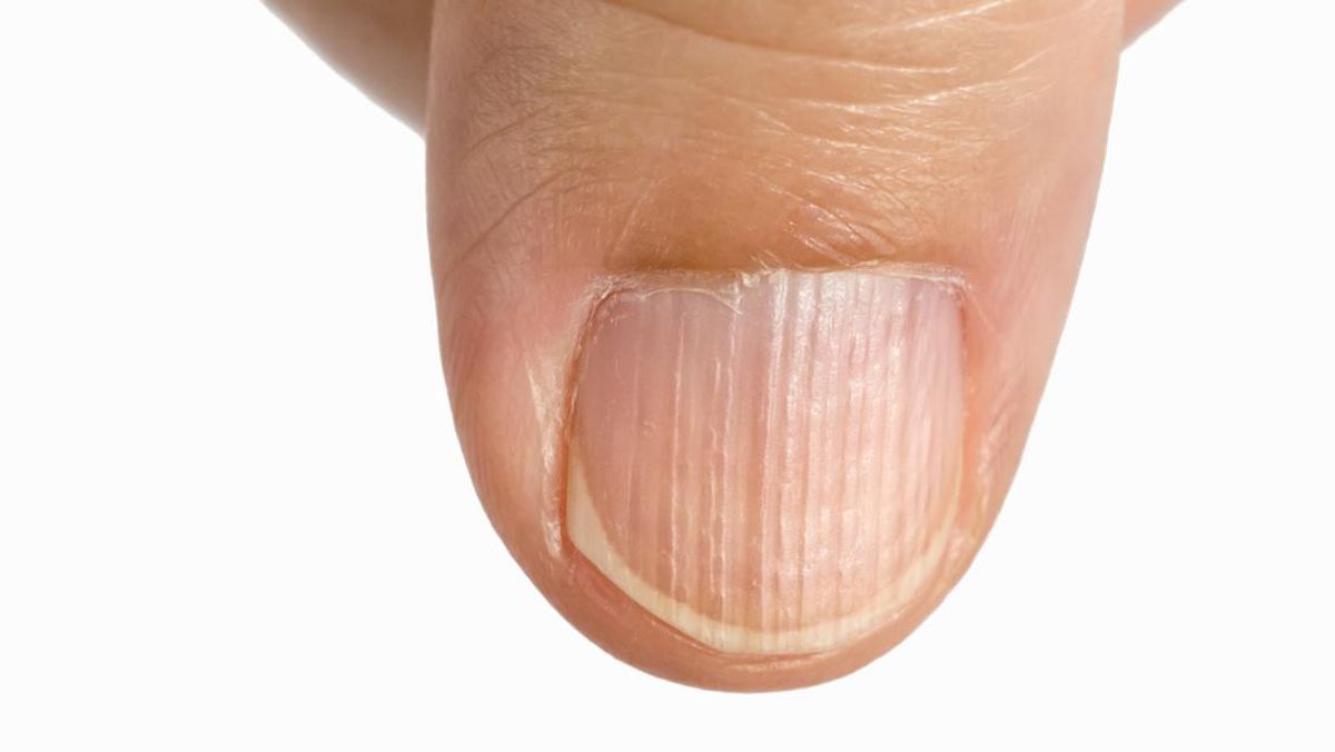 5 Penyebab Kuku Bergelombang Dan Cara Mencegahnya