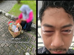 Viral Wajah Pria Bengkak Usai Minum Jamu Sachet, Ternyata Mengandung Ibuprofen