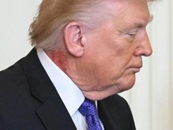Trump Muncul di Gedung Putih dengan Ruam Merah di Leher, Kenapa?