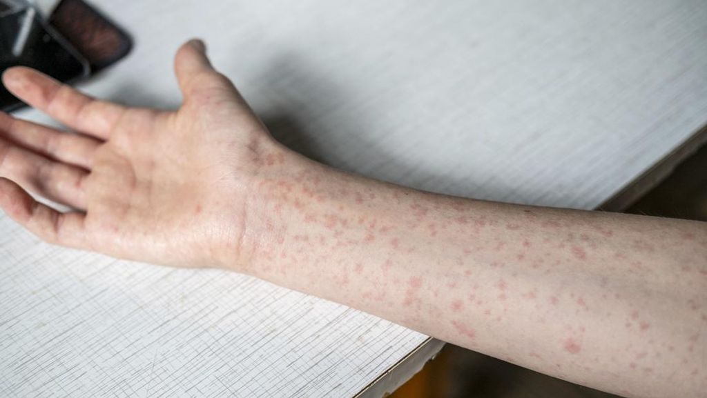 Tak Cuma Anak, Campak pada Orang Dewasa Bisa Picu Komplikasi Serius