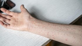 Tak Cuma Anak, Campak pada Orang Dewasa Bisa Picu Komplikasi Serius