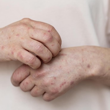 Begini Penjelasan Dokter Soal Perbedaan Ruam Campak dan Cacar Air