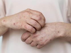 Kasus Campak di RI Meningkat, Pakar IPB Tekankan Pentingnya Vaksin