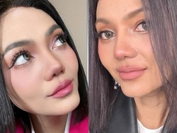 Cerita Rina Nose Alami Post-op Blues usai Oplas Hidung