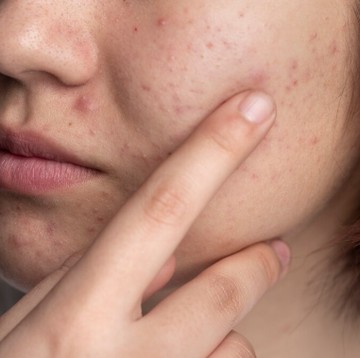 Tips Merawat Kulit Agar Tidak Breakout Menjelang Lebaran