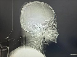 Ngeri! Sumpit Logam 12 Cm Tersangkut di Tenggorokan Pria Selama 8 Tahun