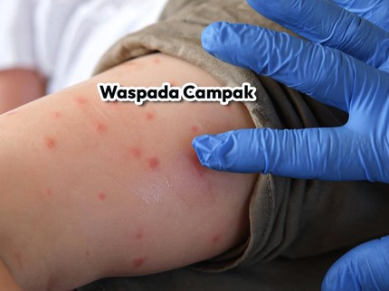 Waspada Campak