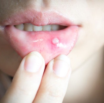 6 Cara Alami Mengobati Sariawan yang Tak Kunjung Sembuh