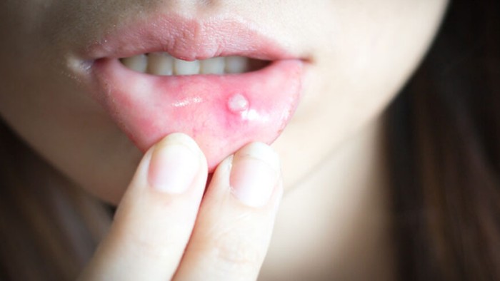 6 Cara Alami Mengobati Sariawan yang Tak Kunjung Sembuh