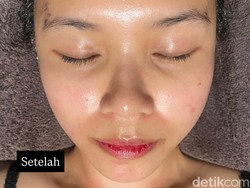 Video: Buccal Facial Contour yang Bikin Wajah Kayak Habis Botox