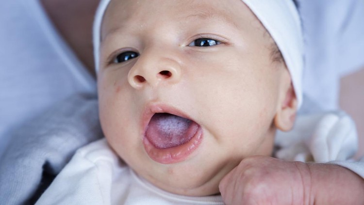 Jamur pada Mulut Bayi&colon; Penyebab&comma; Gejala&comma; Cara Mencegah&comma; & Mengobatinya