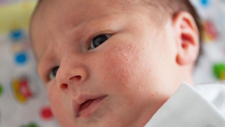 Milia pada Bayi&colon; Penyebab&comma; Jenis & Cara Menghilangkannya