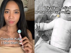Kronologi Wanita Bali Transplantasi Kulit usai Hampir Seluruh Tubuh Kena Luka Bakar