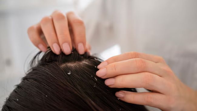 Cara Ampuh Hilangkan Telur Kutu Rambut Pakai Garam, Mudah dan Murah