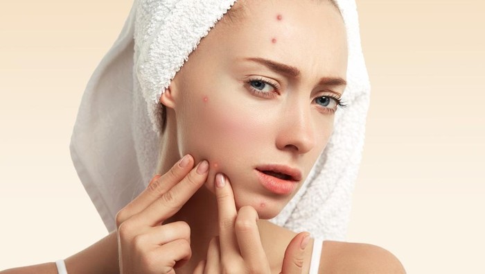 5 Penyebab Jerawat Terus Muncul dan Makin Parah