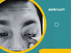 Video: Viral Pria Medan Kena Kanker, Bola Mata Harus Diangkat