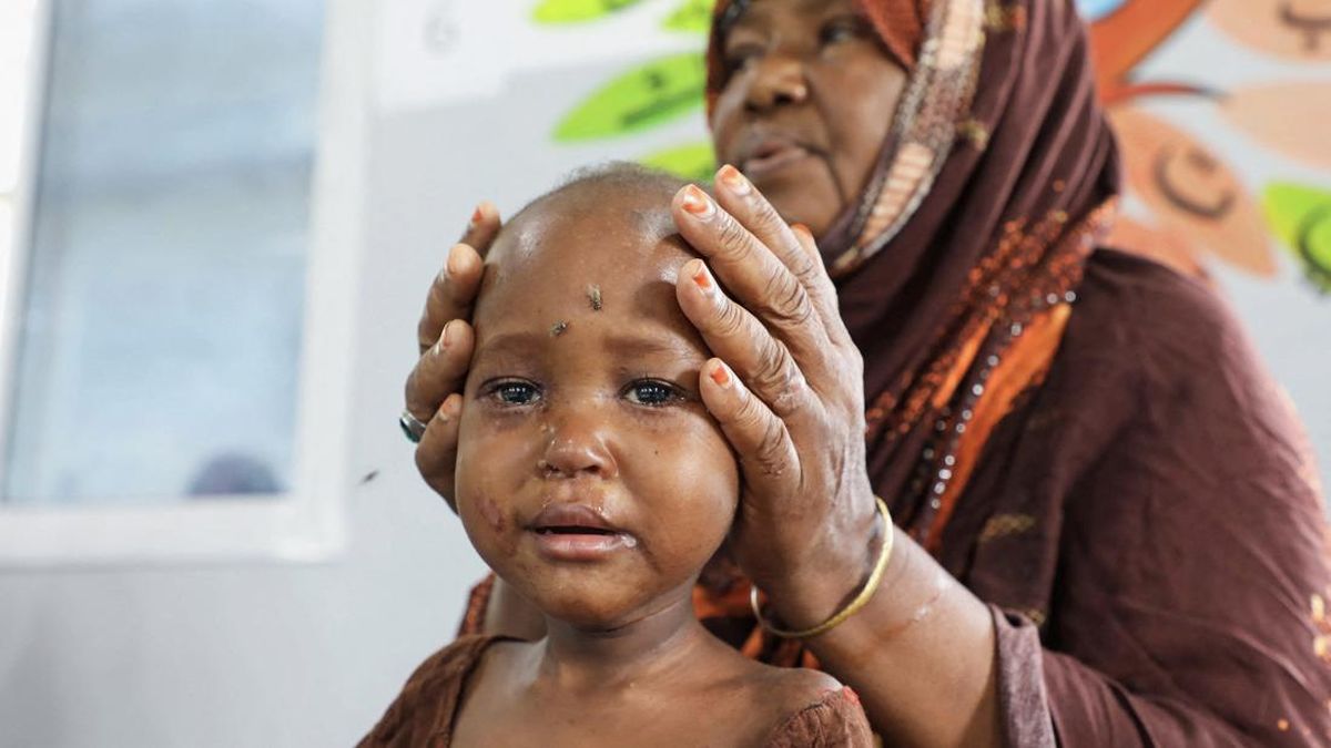 FOTO: Bantuan Terhambat Imbas Perang Iran, Anak-anak Somalia Kelaparan