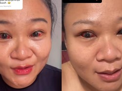 Viral Mata Wanita Memerah Usai Melahirkan, Diduga gegara Merem saat Ngejan