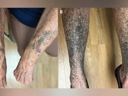 Minum Antibiotik untuk Jerawat, Kulit Wanita Ini Malah Berubah Jadi Hitam-Biru