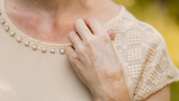 Hand skin pigmentation&period; White-brown leather&period; Melasma&period; Benign pigmentation&period; Hormonal Disorders&period; Medical concept&period;