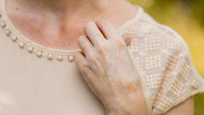 Kisah Perempuan Alami Perubahan Warna Kulit Usai Konsumsi Antibiotik Untuk Jerawat