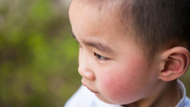 Mengenal Penyakit Fifth Disease, Ruam Merah pada Pipi Anak atau Sindrom Pipi Ditampar