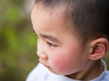 Mengenal Penyakit Fifth Disease, Ruam Merah pada Pipi Anak atau 'Sindrom Pipi Ditampar'