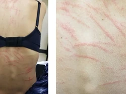 Makan Jamur Shiitake, Punggung Wanita Ini Dipenuhi Ruam Mirip Bekas Cambukan