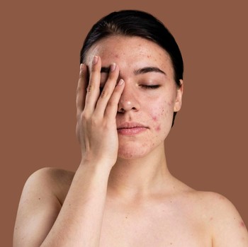 Cara Menghilangkan Bekas Jerawat Hitam Agar Wajah Kembali Cerah dan Mulus