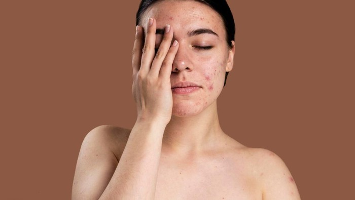 Cara Menghilangkan Bekas Jerawat Hitam Agar Wajah Kembali Cerah dan Mulus