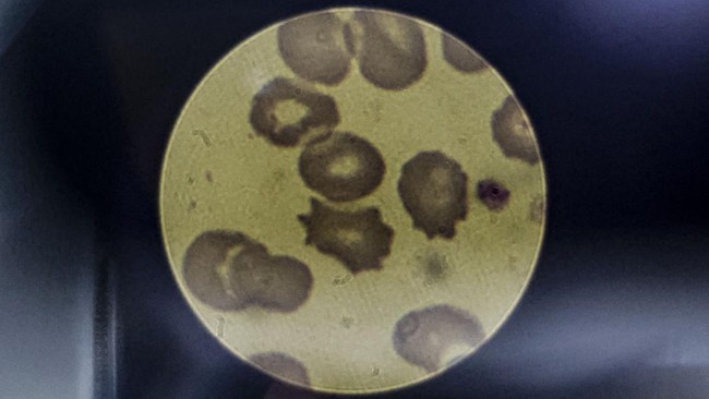 Kasus malaria meningkat di sejumlah wilayah di Afrika. Penyebaran malaria didukung perubahan iklim yang mengubah pola curah hujan dan suhu.