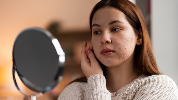 Mengenal Cortisol Face, Wajah yang Membengkak Akibat Stres