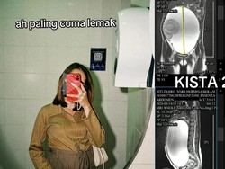 Viral Perut Wanita Bekasi Membesar Dikira Lemak, Ternyata Kista Ovarium 29 Cm