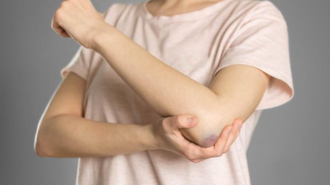 Kisah Viral Perempuan Bekasi Gagal Ginjal Stadium 5, Lebam Jadi Awal Gejala