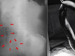 Dokter Sampai Syok! Belut 65 Cm Ditemukan Masih Hidup di Usus Pria Ini