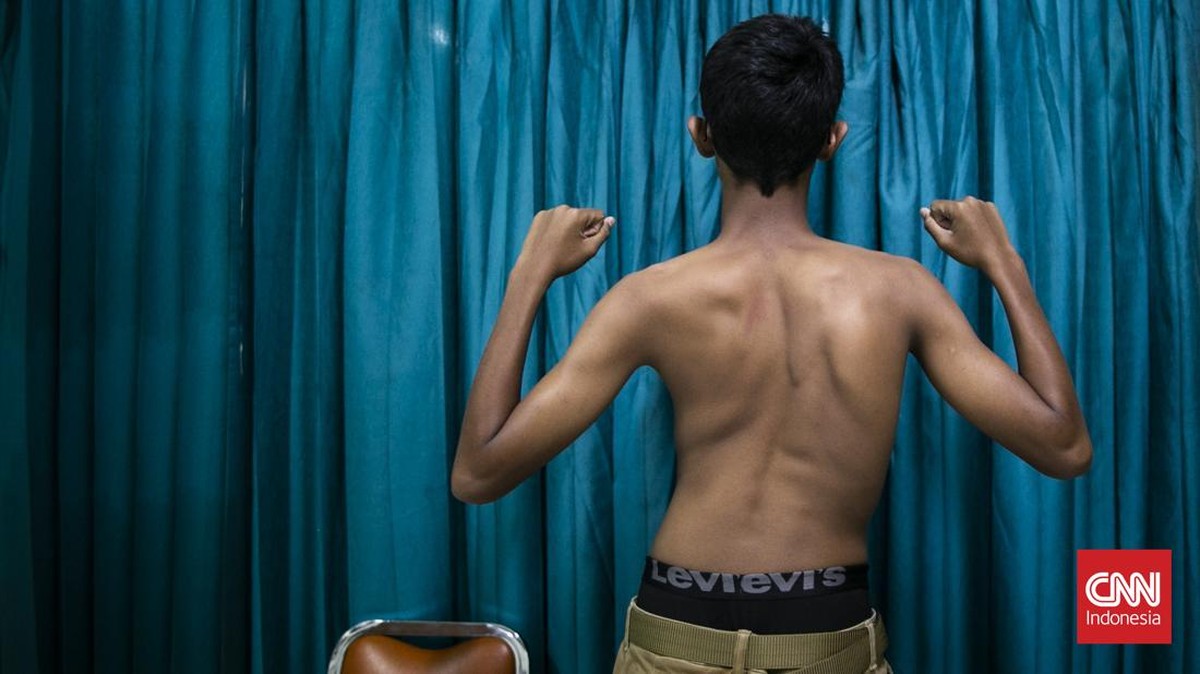 Di balik punggung yang perlahan berubah bentuk, tersimpan kisah perjuangan Refan (14) seorang remaja untuk kembali berdiri tegak melawan skoliosis yang dapat berkembang pesat saat tubuh memasuki fase pertumbuhan. Skoliosis merupakan kondisi tulang be