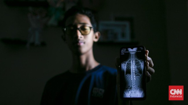 Di balik punggung yang perlahan berubah bentuk, tersimpan kisah perjuangan Refan (14) seorang remaja untuk kembali berdiri tegak melawan skoliosis yang dapat berkembang pesat saat tubuh memasuki fase pertumbuhan. Skoliosis merupakan kondisi tulang be