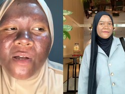Awal Mula Kulit Wanita Ini Menggelap Gegara Krim Merkuri, Kini Berangsur Pulih
