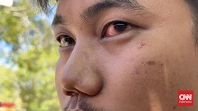 Dirreskrimum Polda Sumbar lepas dari ancaman pidana setelah damai dengan warga yang jadi korban pemukulannya. LBH desak Polda tetap proses etik.