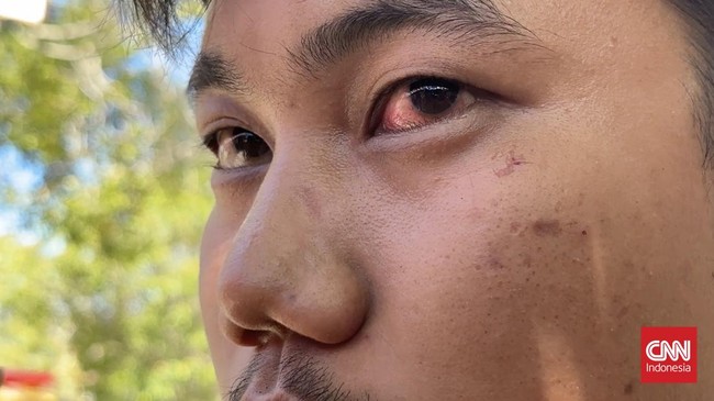 Dirreskrimum Polda Sumbar lepas dari ancaman pidana setelah damai dengan warga yang jadi korban pemukulannya. LBH desak Polda tetap proses etik.