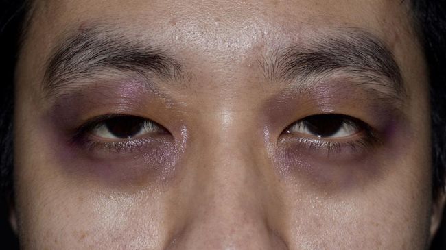 Ada kondisi raccoon eyes atau mata rakun yang bikin penampilan di sekitar mata jadi lebah seperti habis dibogem. Kondisi ini perlu diwaspadai.