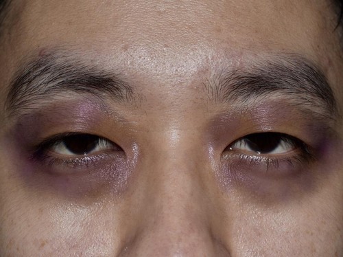 Ada kondisi raccoon eyes atau mata rakun yang bikin penampilan di sekitar mata jadi lebah seperti habis dibogem. Kondisi ini perlu diwaspadai.