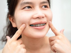Kenapa Pemakai Behel Sering Iyup? Dokter Gigi Ungkap Penyebab dan Cara Mengatasi