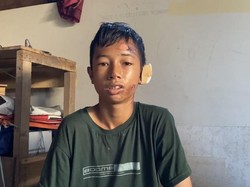 Cerita Relawan Terluka Bakar Usai Halau Karhutla yang Nyaris ke Permukiman