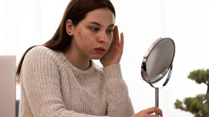 Alasan Stres dan Kurang Tidur Bisa Memicu Jerawat serta Wajah Kusam