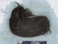 Cerita Dokter Temukan Gumpalan Rambut di Dalam Perut Pasien